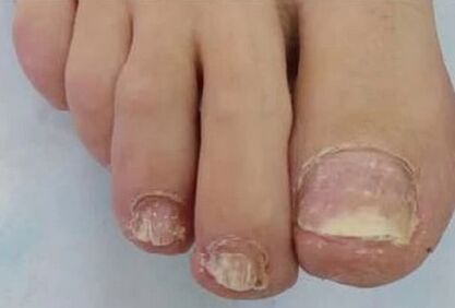 As uñas víronse gravemente afectadas polo fungo