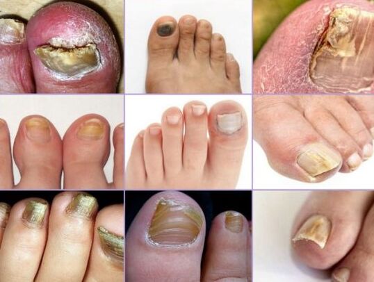 Danos nas uñas en diferentes tipos de cogomelos