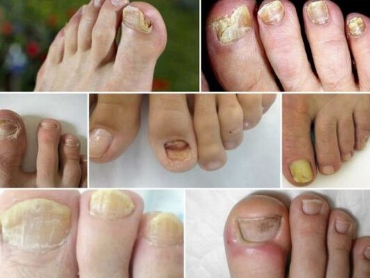 Diferentes formas de fungos de uñas