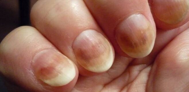 Infección con micose de uñas