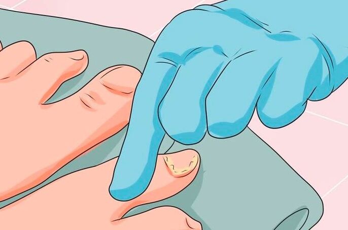 Os primeiros signos de micosis das uñas