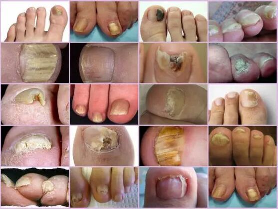Onicomicosis de localización diferente na uña